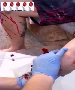 Выдавливание сгустков крови из культи ноги ...
