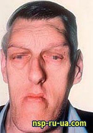 acromegaly