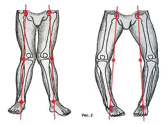 bowlegs_knock_knee_axis