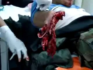 Оторванная мощной петардой кисть