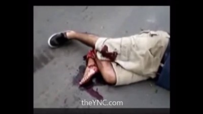 Man in Agony with His Mutilated Leg after Being Hit by Car