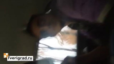 Перелом чешуи