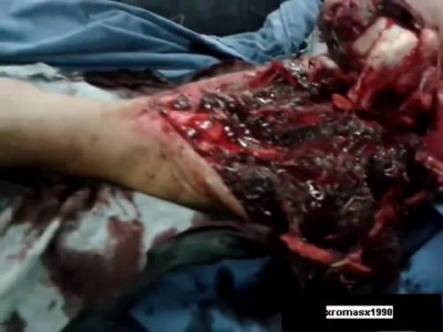 Открытый перелом ноги не шутка ...