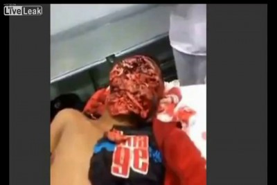 Тяжелая травма лица