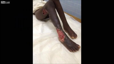 Последствия укуса ядовитых змей фотоподборка