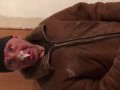 Обморожение