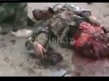 ПАРЕНЬ ПОДОРВАВШИЙСЯ НА БОМБЕ РАЗГОВАРИВАЕТ