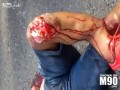 Motorcylce Accident Leaves Leg Mangled